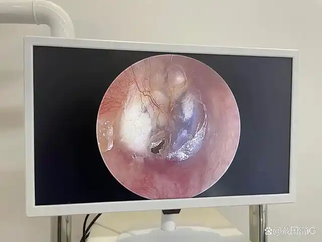 鼓膜钙化,是鼓膜表面钙盐代谢异常,钙质沉积形成的色斑.