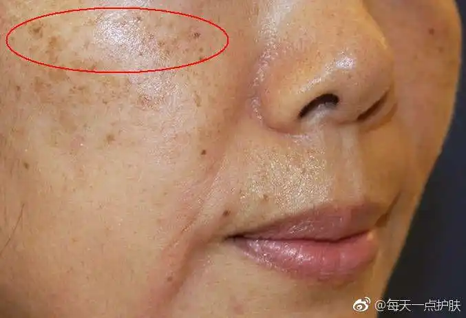 【为什么眼周长斑的人最多呢?】 - 美篇