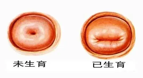 但是,仅仅依靠宫颈口的形状,是不能检查出所有的打胎的.