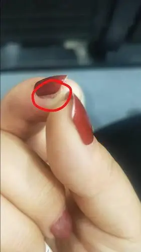 嵌甲,右手食指指甲长进肉里了