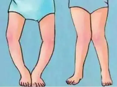 儿童常见畸形之膝内翻和膝外翻