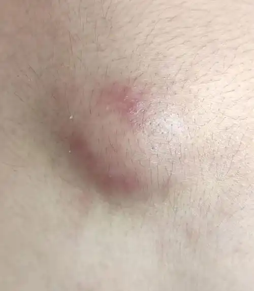 毛囊炎_毛囊炎治疗方式 - 好大夫在线