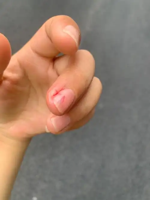 笨手笨脚的女人又受伤了