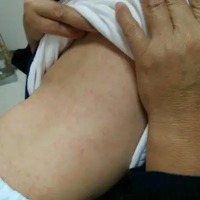 宝宝8个月差2天,一个晚上身上张了很多红点点,是什麼原因造成的?