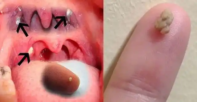 每个人都会长扁桃体结石吗