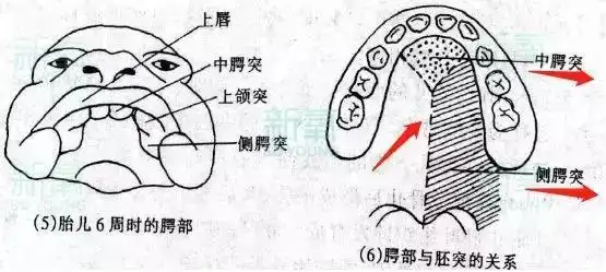 两边侧腭突之间,以及侧腭突和中腭突之间没有融合或者部分融合,就会
