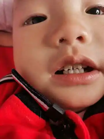 宝宝门牙牙齿有缺口,这是怎么回事?先是有一层黄然后就这样了