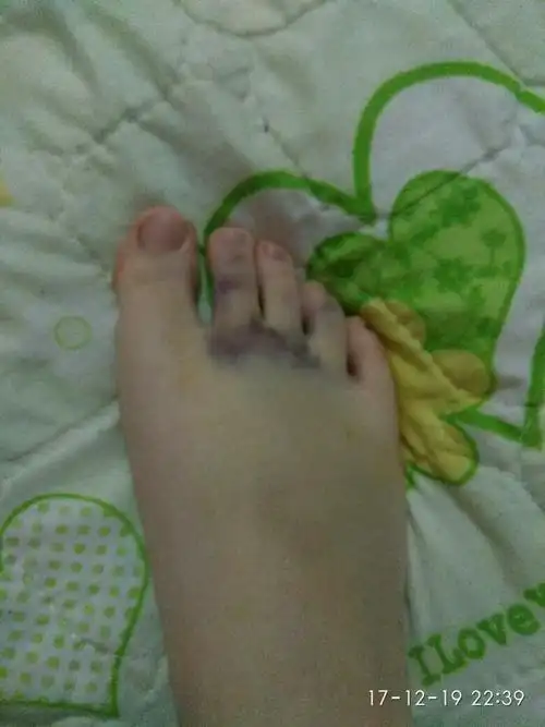 前几天被人踩了一脚,粗高跟,脚背内块疼 ,又青又肿,脚趾一大幅度的