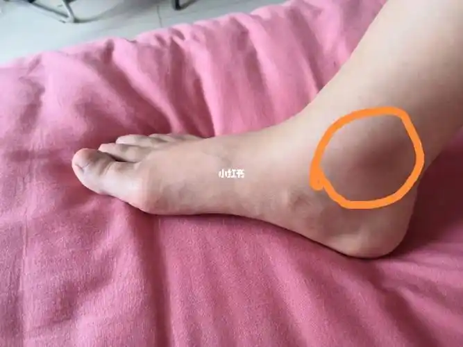 内侧脚踝画圈地方疼,做完有氧运动开始疼,有知道什么原因吗