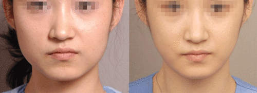 打瘦脸针前后效果对比