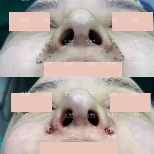 膨体鼻基底填充