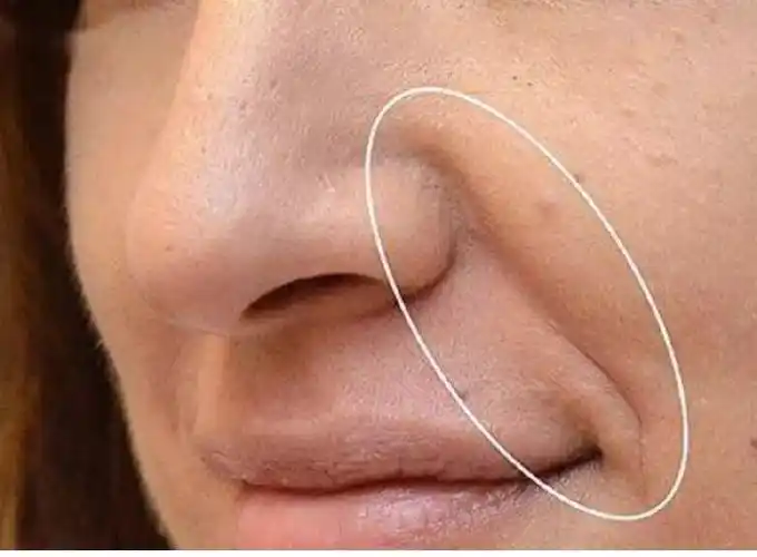 法令纹是出现衰老后鼻两侧皮肤的下垂凹陷,一般是在鼻翼边延伸而下的