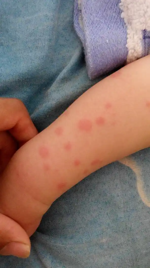 宝宝荨麻疹怎么办?这种情况都有两个月了!