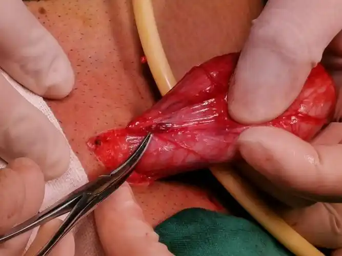 高清显微镜下精索静脉曲张修复手术在潍坊市中医院东院区泌尿外科成功