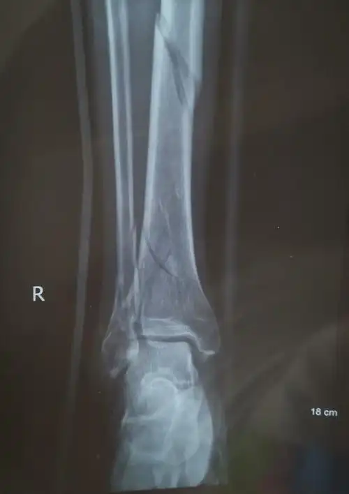 胫骨骨折伴踝关节骨折手术分享