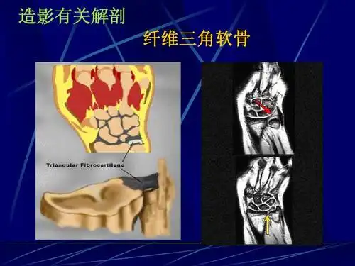 造影有关解剖 纤维三角软骨
