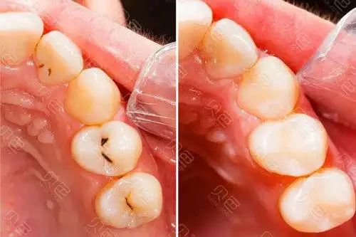 牙齿刚补完就有酸痛感,是医生没补好还是?