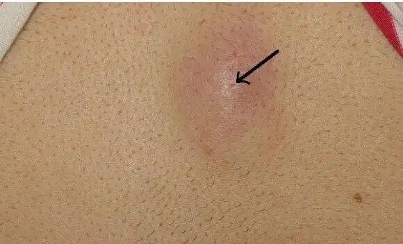 "粉瘤"---皮脂腺囊肿_皮脂腺囊肿_介绍_症状表现_检查_治疗方式_日常