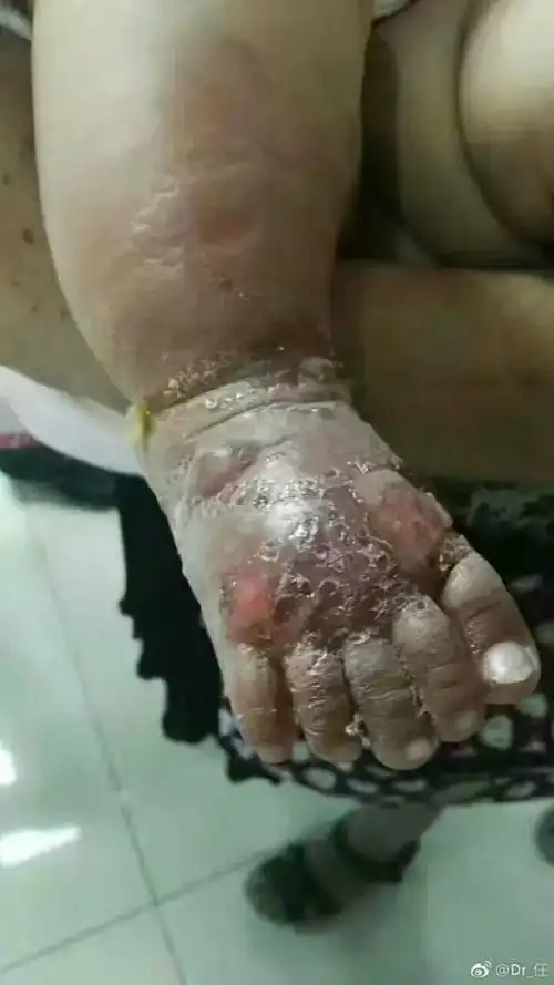 老人用无花果水给孩子洗脚,致其双脚肿胀溃烂惨不忍睹