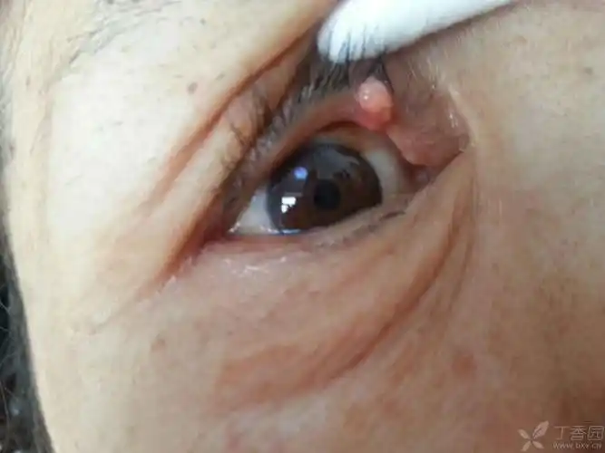 求助女60岁上眼睑肿物切除术后7天病理睑板腺癌求助下一步治疗方案