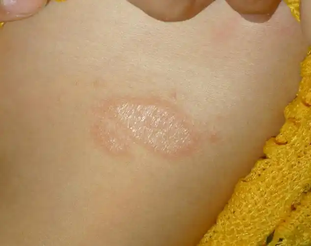 玫瑰糠疹:究竟是什么"鬼"?-郭波主治医师-爱问医生