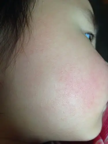 请问,宝宝的脸长像脂肪粒一样的东西是怎么