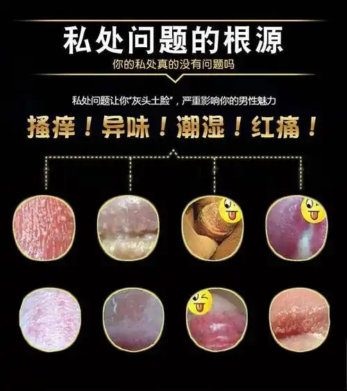 龟头炎包皮炎梅毒溃疡面尖锐湿疣生殖器的疱疹珍康喷剂男科抑菌膏1