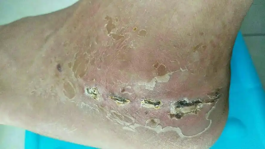 病例6,男,岁.跟骨骨折急诊8小时内手术.金医生管床.喜欢喂鸟.