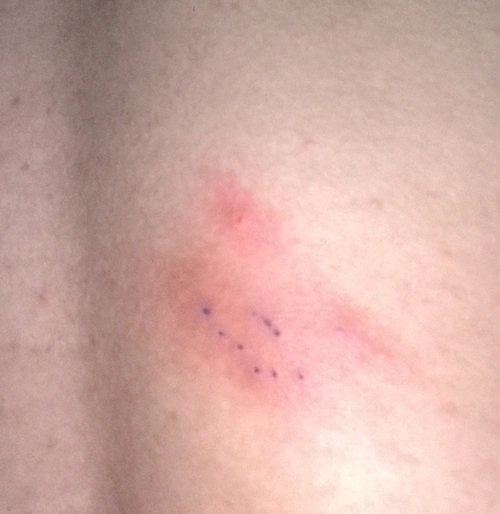 微疼,摸起来有点浮肿,刚才拍了看了下有几个黑点,有点疼,在后背