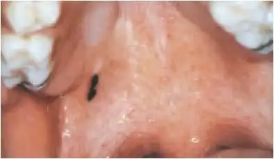 恶性黑色素瘤恶性黑色素瘤又称黑色素瘤,是由黑色素细胞或黑色素前体