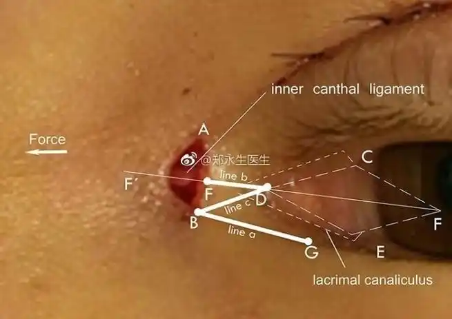 开眼角使用z瓣来减少张力性瘢痕 - 好大夫在线