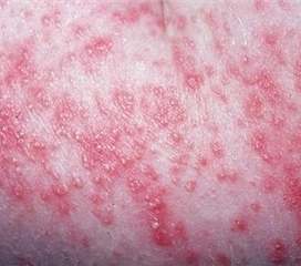 泌尿生殖系真菌病【多图】_39医疗图集-39健康网