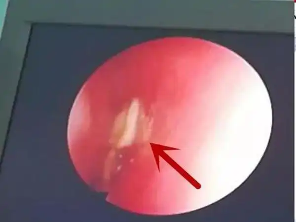 市儿童医院为三岁患儿取出堵塞鼻腔四个多月的小粘贴