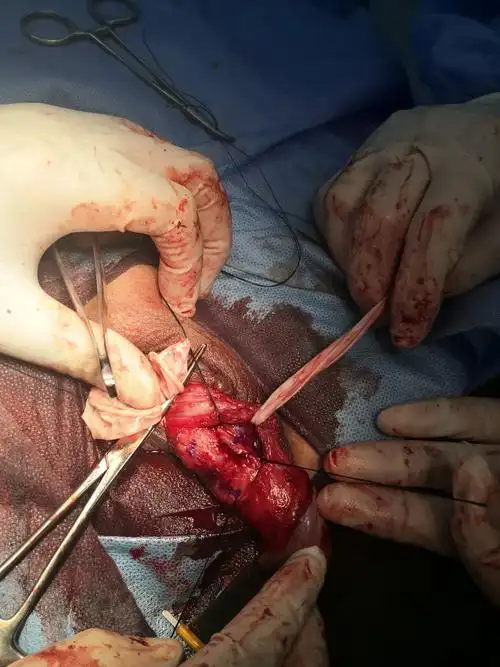 症患者阴茎海绵体斑块切除 脱细胞异体真皮修补白膜缺损 阴茎矫直术