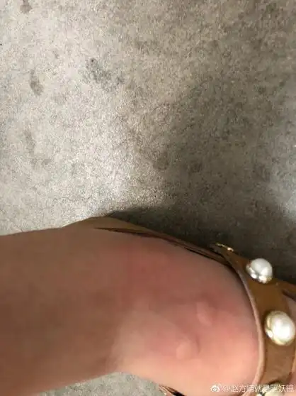 白纹伊蚊咬的包图片 伊蚊在中国的分布情况是怎样的