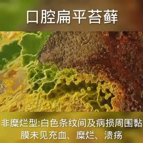 口腔扁平苔藓【视频二】