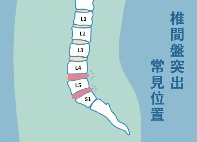 同样是腰突为何腰45腰5骶1更爱突出