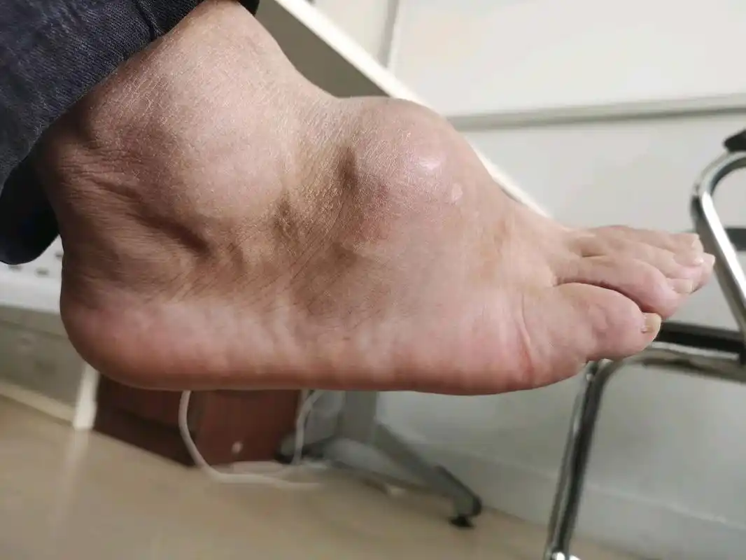 别让痛风石吃掉你的脚!