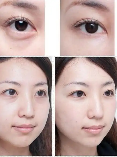 有些宝宝们,傻傻分不清,会将泪沟误认为是眼袋.