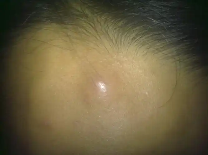 脑门和侧脸长了两个包?是怎么了?