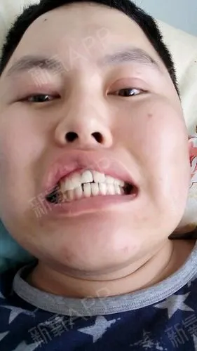 小时候是多生牙,门牙中间多长一颗,由于当时家庭条件_圈子-新氧美容