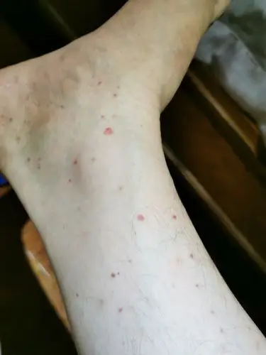 形形色色的紫癜和要命的出血点