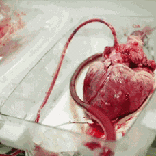 图文心脏移植的过程怎么移怎么植