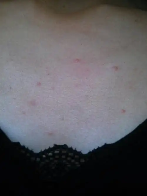 胸口长痘是怎么回事,背上却没有长痘,这是为什么,我现在在苏州.