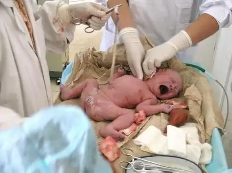 【图文】堪比恐怖解剖室的剖腹产手术