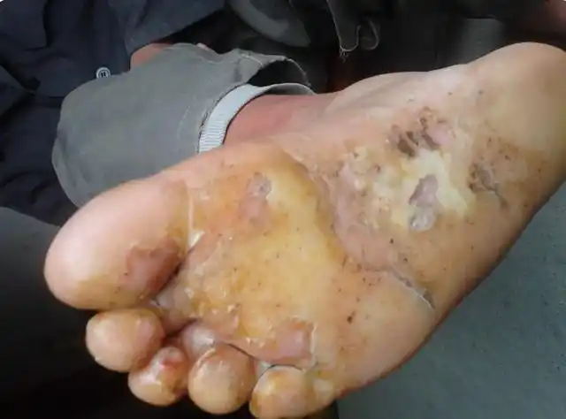 角化型足癣症状图片