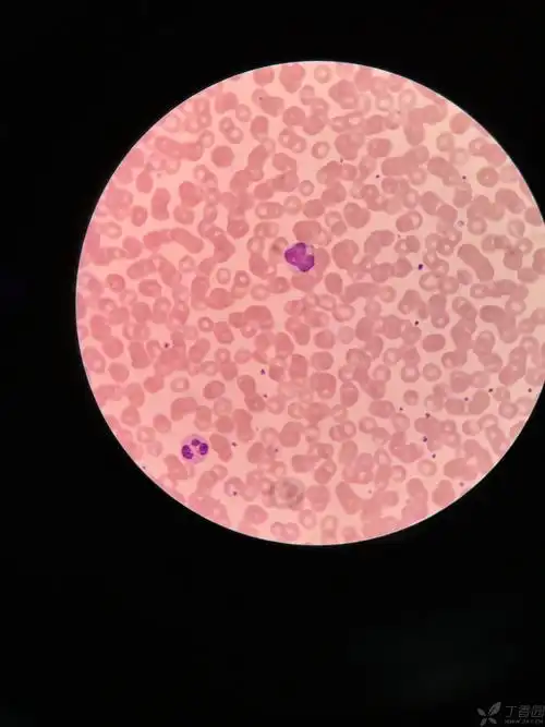 谢谢,再想请教一个问题,怎样辨别异型淋巴细胞中的单核细胞型和单核