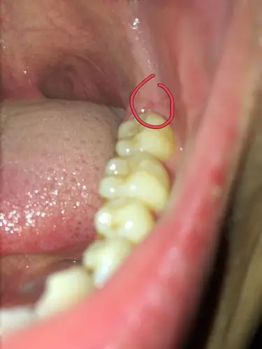 这个地方有个破口,是口腔溃疡吗?可以放大看