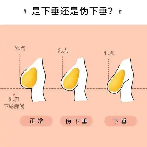 纺锤型乳房的底盘不大,但隆起很高,使乳房向前突出并稍有垂态.