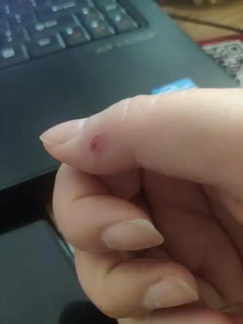 被一只奇怪的老鼠咬到了怎么办